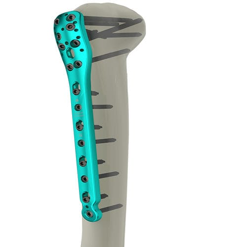 Компрессионная костная пластина плечевая кость - 10-2200 series - WishBone Medical - проксимальная / блокируемая