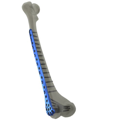 Компрессионная костная пластина бедренная кость - WishBone Medical - дистальная / блокируемая / из титана