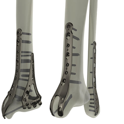 Компрессионная костная пластина большеберцовая кость - STEP®  - WishBone Medical - малоберцовая кость / для лодыжки / дистальная