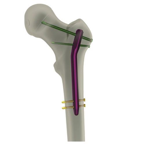 Интрамедуллярный штифт бедренная кость - PediFIN® - WishBone Medical - проксимальная фиксация / педиатрический