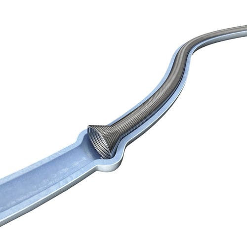 Мочеточниковый стент - SURSM series - Surgsci Medical - из металла