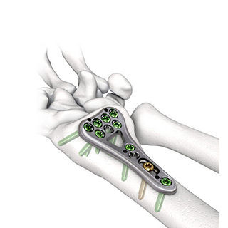 Компрессионная костная пластина лучевая кость - Changzhou Dingjian Medical Equipment - дистальная / блокируемая / металлическая