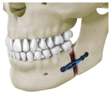 Костная пластина для остеотомии для нижней челюсти - Delphos Implants - металлическая
