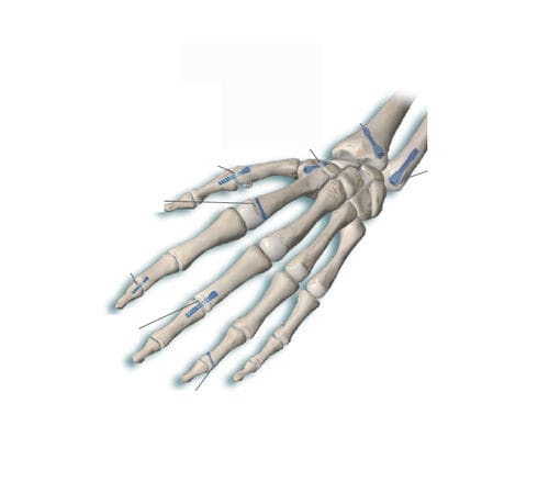 Компрессирующий винт для кости пясть - Delphos Implants - для фаланги руки / без головки / металлический