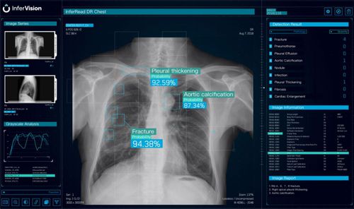 Программное обеспечение для анализа - DR Chest - Beijing Infervision Technology Co. Ltd. - для визуализации / для составления отчетности / медицинское