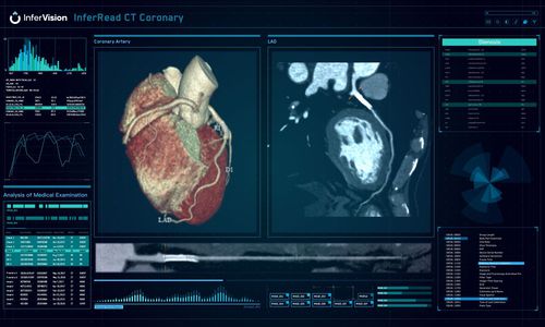 Медицинское программное обеспечение - InferRead® - Beijing Infervision Technology Co. Ltd. - TDM / для анализа / для управления данными