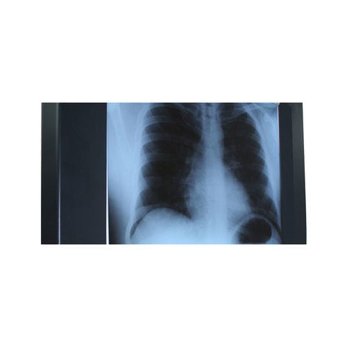 Негатоскоп 1 диапазон - Woodmans Meditech - светодиод