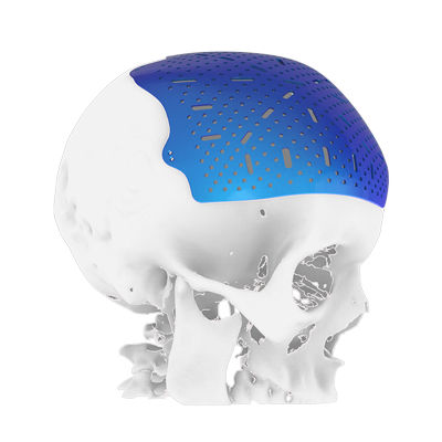 Черепной имплантат на заказ - Osteophoenix
