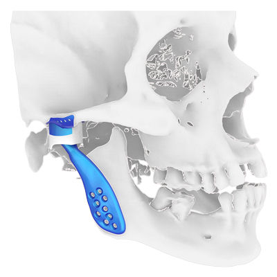 Имплантат височно-нижнечелюстного сустава на заказ - Osteophoenix