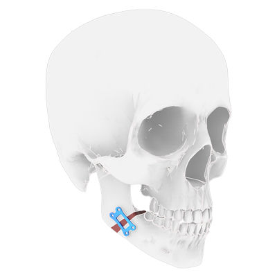 Костная пластина для остеотомии для нижней челюсти - Osteophoenix - из титана