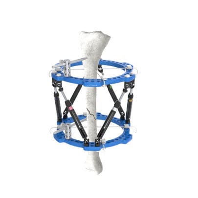 Внешний фиксатор большеберцовая кость - Wuxi Betta Medical Technology - для щиколотки / циркулярный
