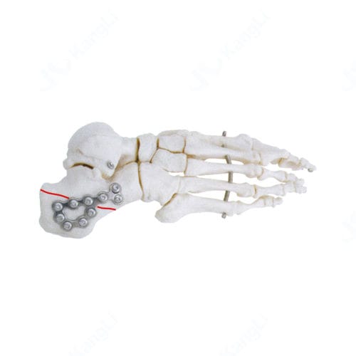 Компрессионная костная пластина для пяточной кости - T3010 - Kangli Medical - неблокируемая / из титана