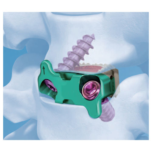 Межтеловой кейдж шеи - G-58020 - Kangli Medical - через передний отдел / из ПЭЭК