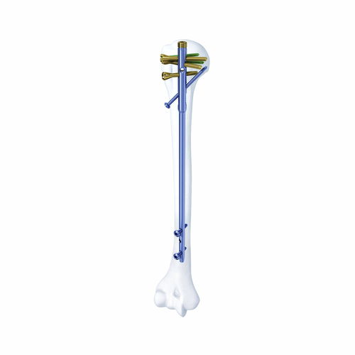 Интрамедуллярный штифт плечевая кость - SHGK - Chongqing FWS Medical Device - проксимальная фиксация / диафизарная фиксация / металлический