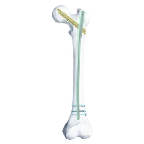 Интрамедуллярный штифт бедренная кость - SGG - Chongqing FWS Medical Device - из титана