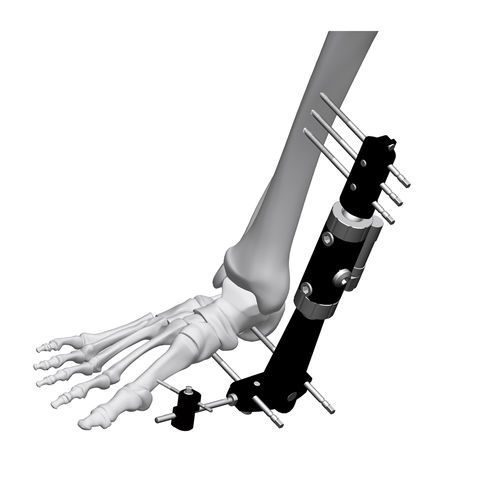 Внешний фиксатор для щиколотки - FE8M-D050   - Chongqing FWS Medical Device - трубчатый