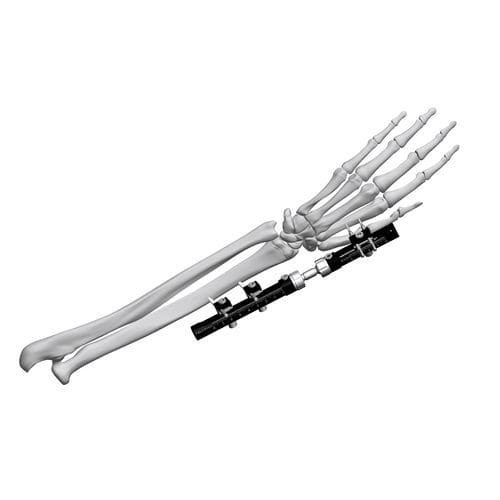Внешний фиксатор для запястья - FE5M-D030  - Chongqing FWS Medical Device - трубчатый