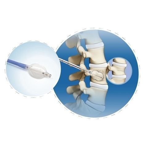 Комплект инструментов для чрескожной кифопластики - FWS-007 series - Chongqing FWS Medical Device