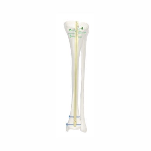Интрамедуллярный штифт большеберцовая кость - SJGK - Chongqing FWS Medical Device
