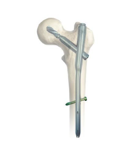 Интрамедуллярный штифт бедренная кость - SGM - Chongqing FWS Medical Device - проксимальная фиксация / из титана