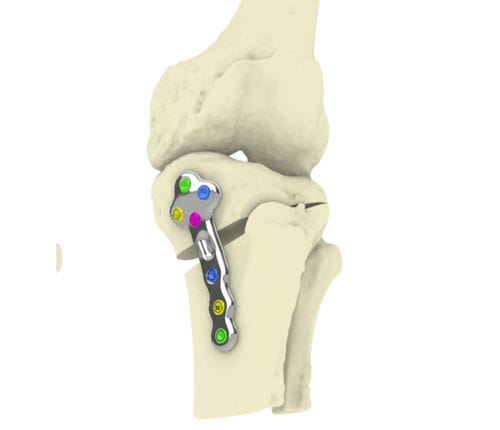 Костная пластина для остеотомии большеберцовая кость - TOKA - Orthoscape - блокируемая / металлическая