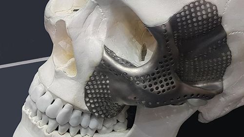 Имплантат параорбитальной области на заказ - OrthoCMF - Orthoscape - нерассасывающийся