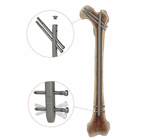 Интрамедуллярный штифт бедренная кость - AS.AFN.400 - Ases Orthopedics - проксимальная фиксация / дистальная фиксация / правый