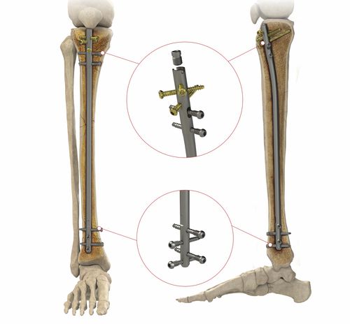 Интрамедуллярный штифт большеберцовая кость - AS.ATN.401 - Ases Orthopedics - проксимальная фиксация / дистальная фиксация / из титана