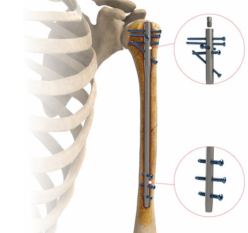 Интрамедуллярный штифт плечевая кость - AS.HUM.402 - Ases Orthopedics - диафизарная фиксация / проксимальная фиксация / правый