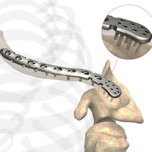 Компрессионная костная пластина для ключицы - AS.SH.029 - Ases Orthopedics - дистальная / блокируемая / неблокируемая