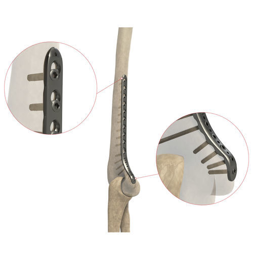 Компрессионная костная пластина плечевая кость - AS.E.020 - Ases Orthopedics - дистальная / медиальная / блокируемая