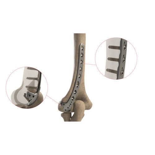 Компрессионная костная пластина плечевая кость - AS.E.022 - Ases Orthopedics - дистальная / заднебоковая / блокируемая