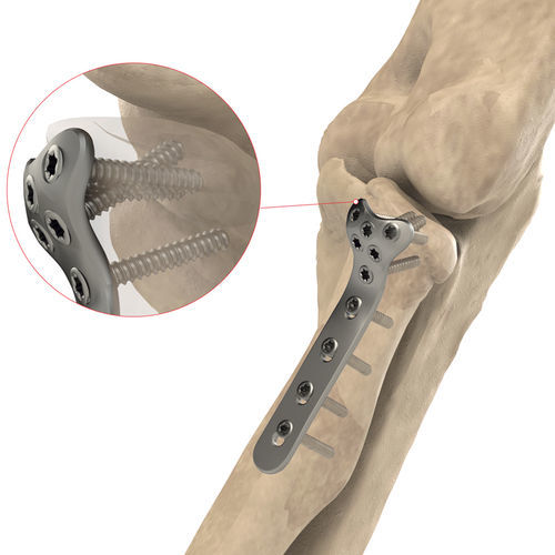 Компрессионная костная пластина для головки лучевой кости - AS.E.019 - Ases Orthopedics - проксимальная / блокируемая / из титана