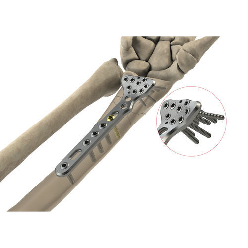 Компрессионная костная пластина лучевая кость - AS.W.011 - Ases Orthopedics - дистальная / блокируемая / неблокируемая