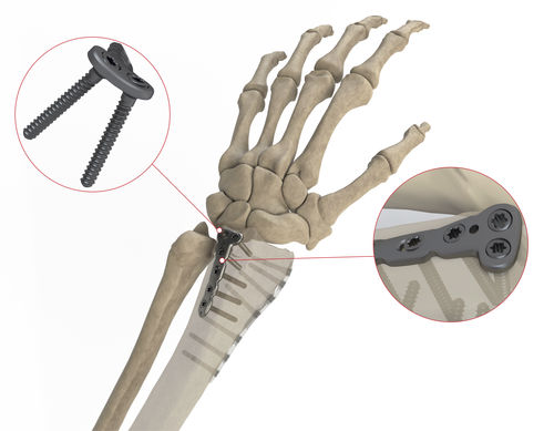 Компрессионная костная пластина лучевая кость - AS.W.014 - Ases Orthopedics - дистальная / дорсальная / блокируемая