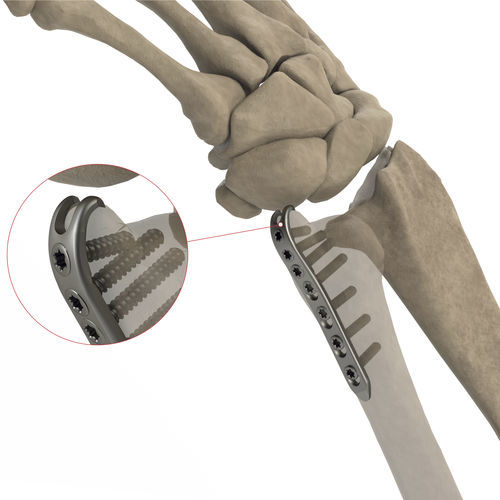 Компрессионная костная пластина локтевая кость - AS.W.016 - Ases Orthopedics - дистальная / блокируемая / неблокируемая