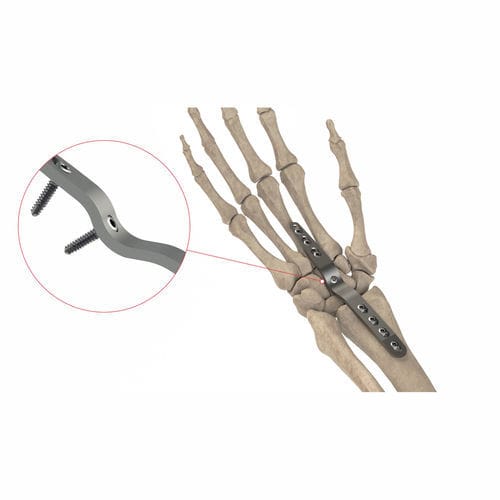 Костная пластина для артродеза для запястья - AS.W.074 - Ases Orthopedics - дорсальная / блокируемая / неблокируемая