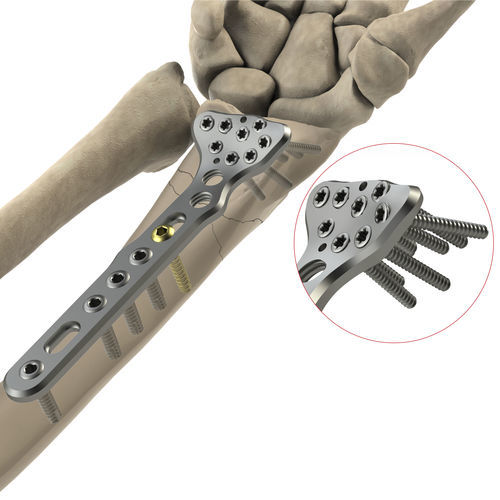 Компрессионная костная пластина лучевая кость - DR Volar II - Ases Orthopedics - дистальная / ладонная / блокируемая