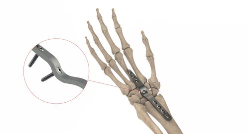 Компрессионная костная пластина для лучезапястного сустава - HC Artrodesis LP - Ases Orthopedics - блокируемая
