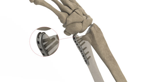 Компрессионная костная пластина локтевая кость - Styloid LP - Ases Orthopedics - блокируемая