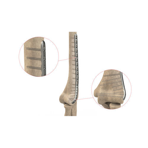 Компрессионная костная пластина плечевая кость - Ases Orthopedics - дистальная / боковая / блокируемая