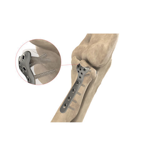 Компрессионная костная пластина лучевая кость - Ases Orthopedics - блокируемая