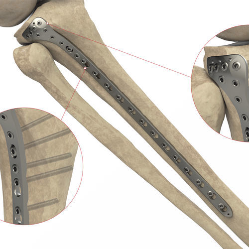 Компрессионная костная пластина большеберцовая кость - Ases Orthopedics - проксимальная / боковая / блокируемая