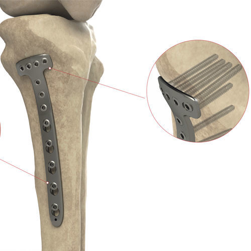 Компрессионная костная пластина большеберцовая кость - Ases Orthopedics - проксимальная / медиальная / блокируемая