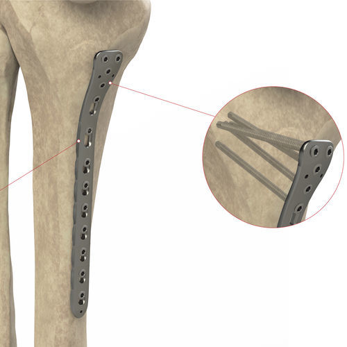 Компрессионная костная пластина большеберцовая кость - Ases Orthopedics - проксимальная / медиальная