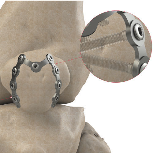 Компрессионная костная пластина для надколенника - Ases Orthopedics - блокируемая