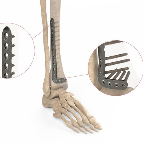 Компрессионная костная пластина большеберцовая кость - Ases Orthopedics - дистальная / переднебоковая / блокируемая
