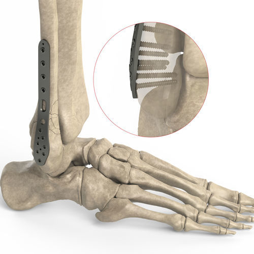 Компрессионная костная пластина малоберцовая кость - Ases Orthopedics - дистальная / боковая / блокируемая