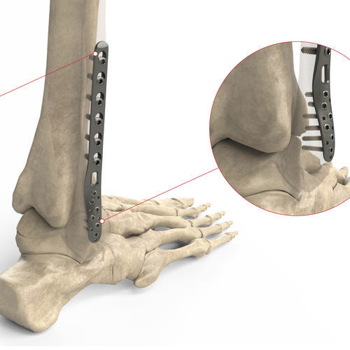 Компрессионная костная пластина малоберцовая кость - Ases Orthopedics - дистальная / боковая / блокируемая