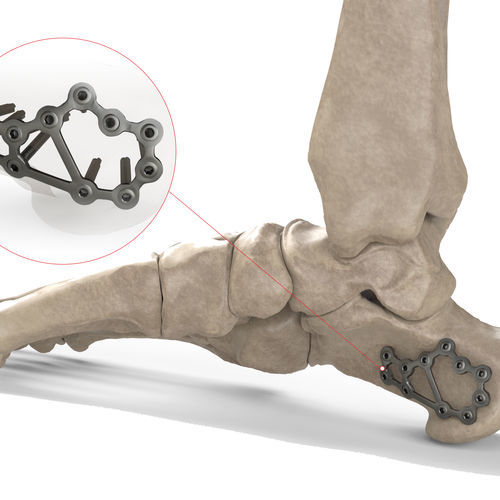 Компрессионная костная пластина для пяточной кости - Ases Orthopedics - блокируемая
